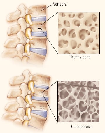 osteoporosis 